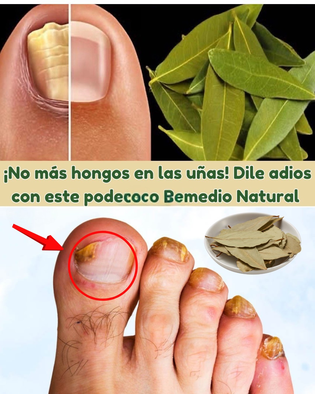 Remedio Natural con Laurel para Hongos en las Uñas