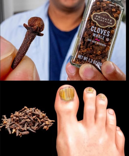 Clavos de olor y tratamiento de hongos en las uñas