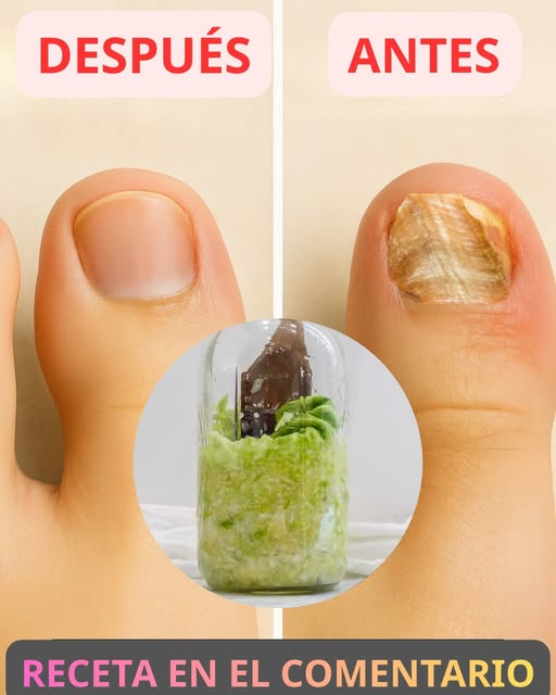 Remedio casero para hongos en uñas
